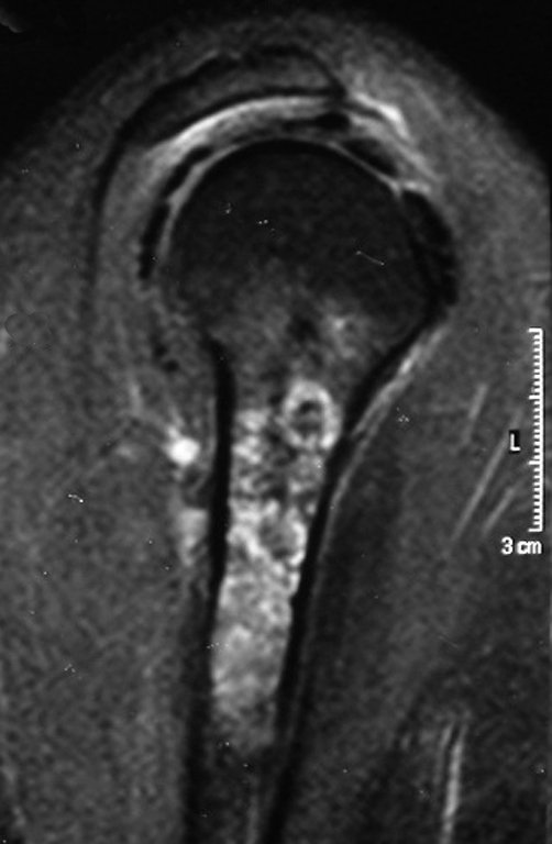 Figura 4.B: Ressonância em sagital T1 Spir, verifica-se erosão da cortical interna, lesões em saca bocado.