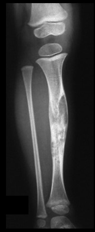 Figura 22: Evolução na radiografia de frente, em 17/03/2009.