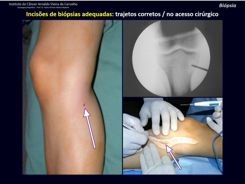 Figura 86: Cicatriz puntiforme de BIÓPSIA CORRETA, realizada com agulha de Jamshid, permitindo a ressecção do tumor com margem, juntamente com o trajeto da biópsia.