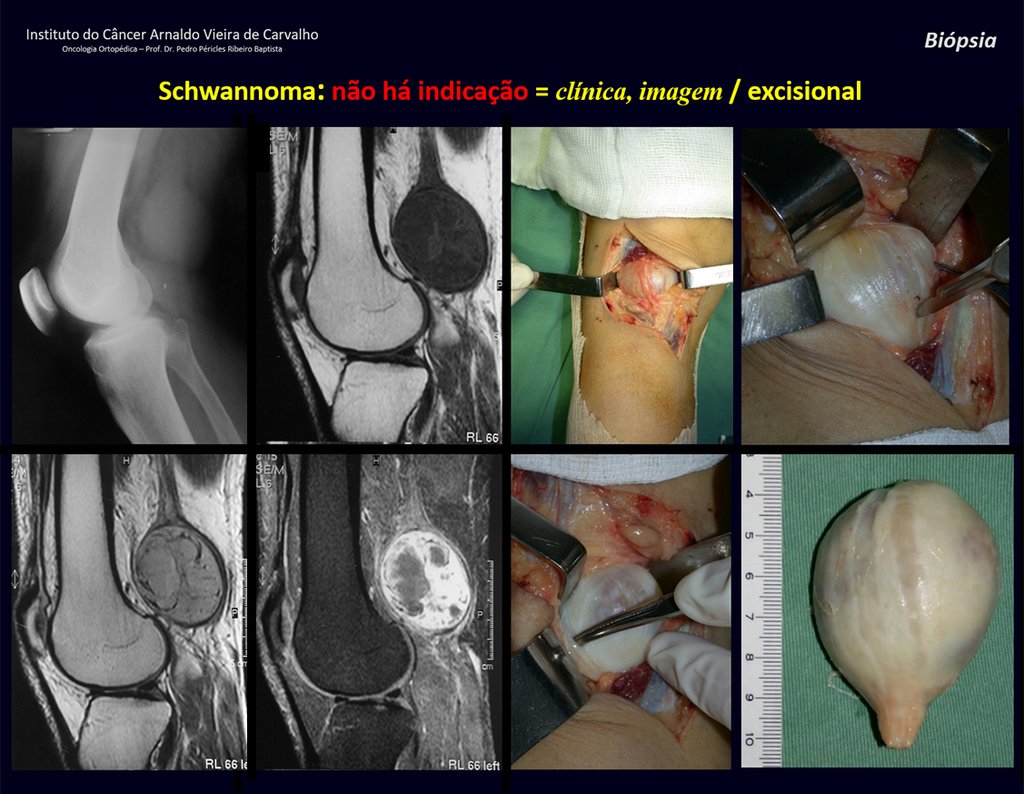 Figura 76: Radiografia com tumor no cavo poplíteo. Ressonância em T1 e T2 desenhando a “cauda de cometa” em trajeto nervoso. Exérese da lesão que parece uma cebola. Abre-se cuidadosamente a bainha (“casca da cebola”) e a lesão é retirada por completo, sem lesar o nervo.