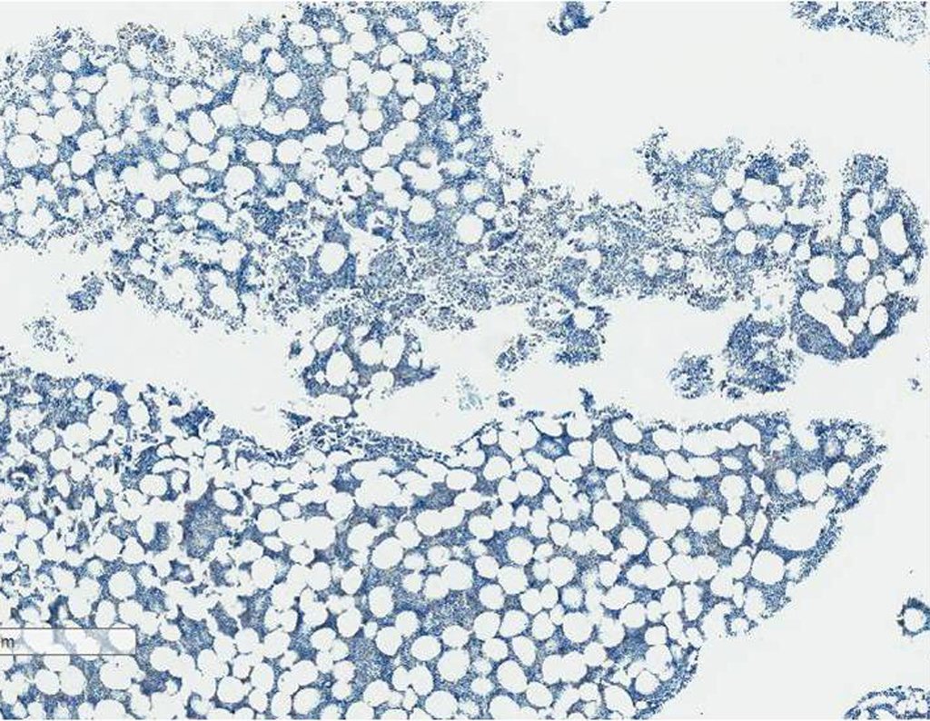 Figura 117: Imuno Histoquímico – marcador epitelial AE1AE3 negativo.