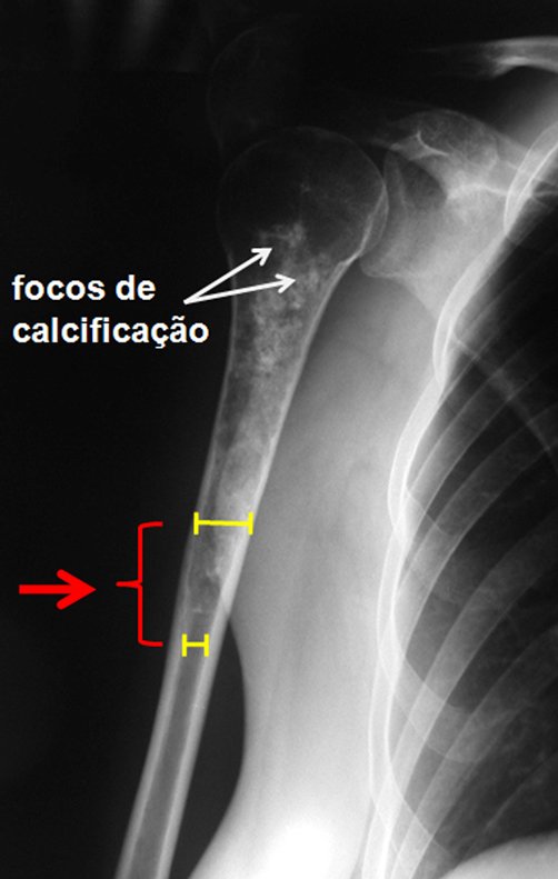 Figura 6.A: Rx do úmero com lesão meta-diafisária, com focos de calcificação, alargamento da medular e erosão da cortical interna.