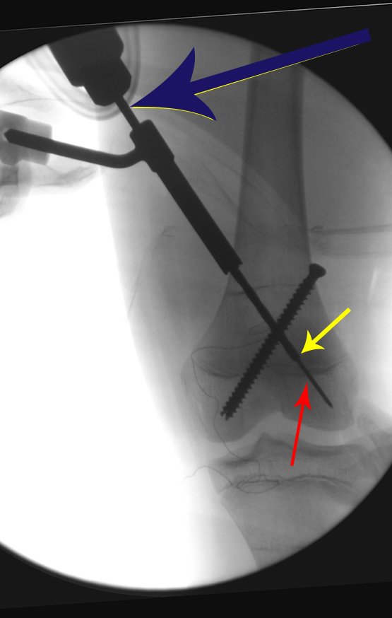 Figura 179: Perfuração com broca, para o parafuso medial. Seta azul, broca canulada. Seta amarela, controle da extremidade da perfuração, que deve ultrapassar a fise de crescimento. Seta vermelha aponta o fio guia