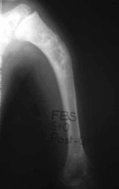 Figura 3: Radiografia frente, após a quimioterapia neoadjuvante, mostrando boa resposta radiográfica, em 15/05/1991.