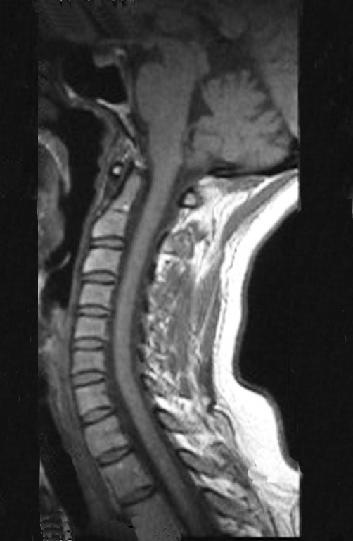 Figura 2: Ressonância (RM) da coluna cervical sagital (sag) T1, normal.