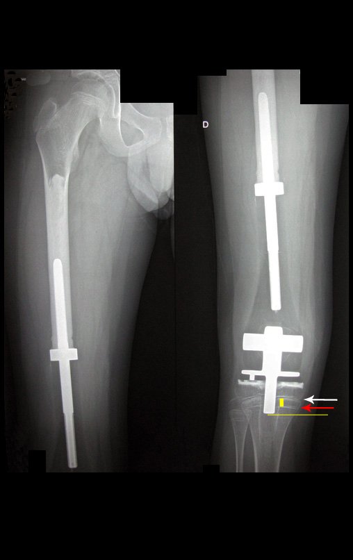 Figura 130: Radiografia de 17/06/2015, após um ano e um mês da cirurgia, seta branca aponta a posição atual da fise de crescimento, seta vermelha aponta a cicatriz da posição anterior da placa de crescimento.