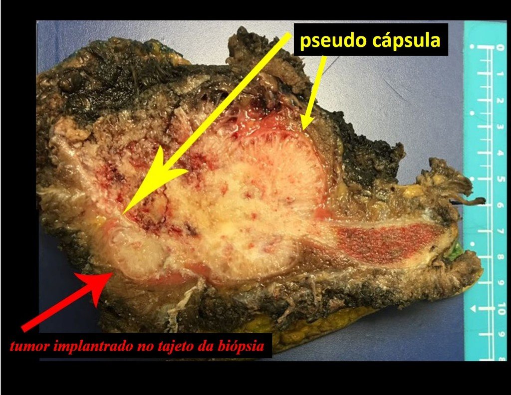 Figura 109: Corte da peça ressecada, observando-se as margens marcadas com tinta nanquim.