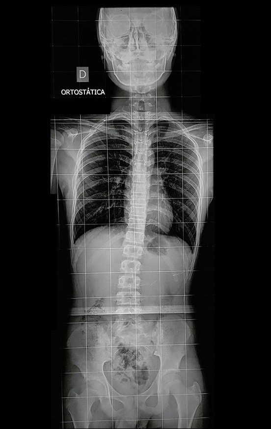 Figura 167: Radiografia com inclinação da bacia e atitude escoliótica, consequente ao encurtamento.