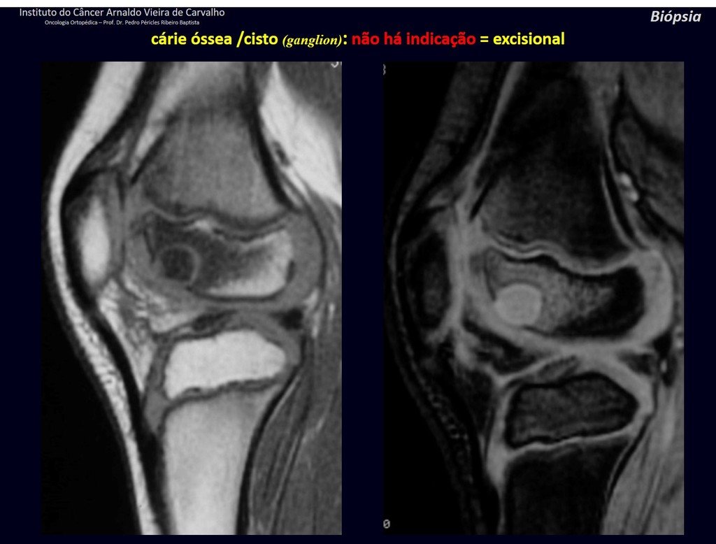 Figura 62: Ressonâncias sagitais T1 e com contraste evidenciando a delimitação periférica da lesão, que não se comunica com a articulação. Lesão de conteúdo líquido homogêneo e muito pequena, pode ser tratada sem biópsia.