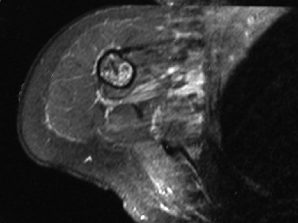 Figura 5.C: RM T1 Spir, observam-se erosões em saca bocado da cortical interna.