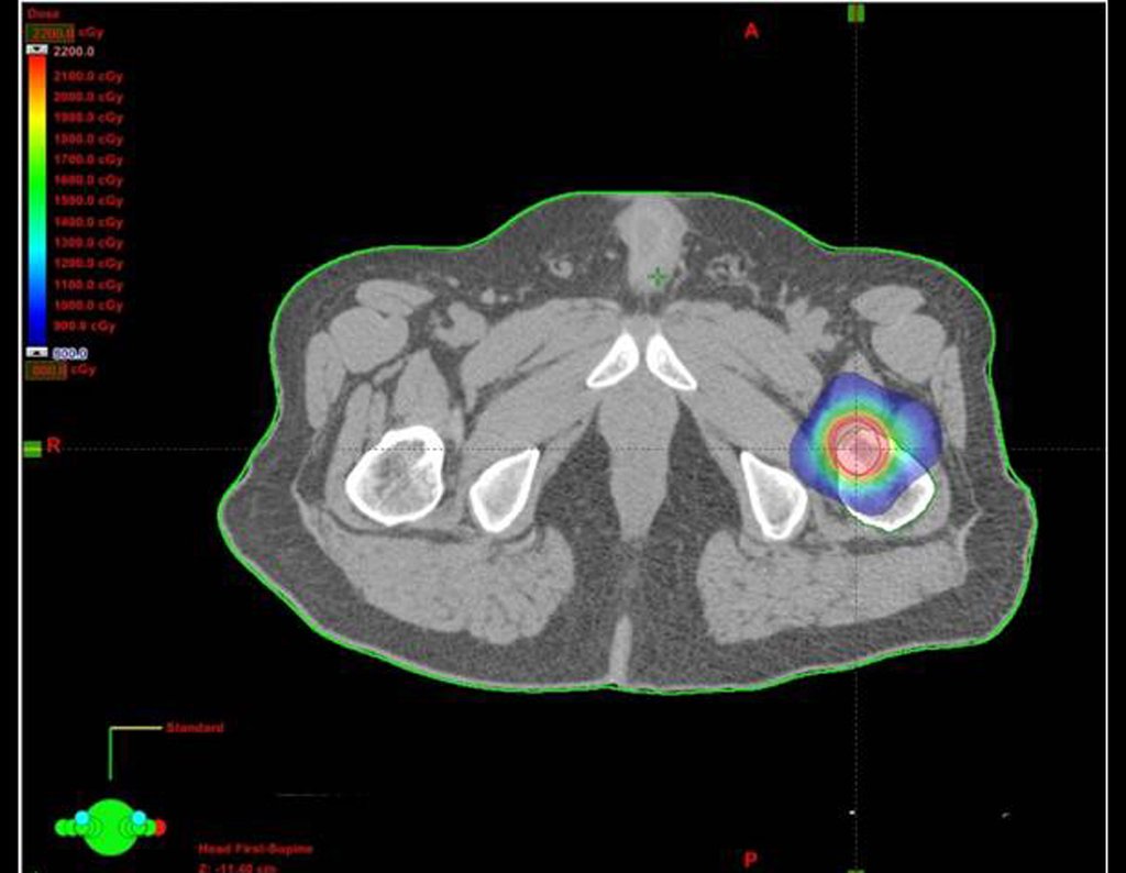 Figura 26f: Imagem de TC em corte axial com distribuição de dose da radiação.