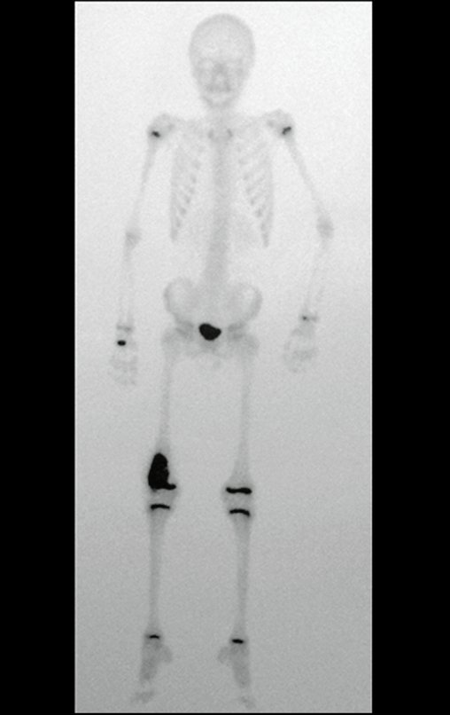 Figura 4 : Cintilografia ampliada evidenciando hipercaptação no fêmur direito.