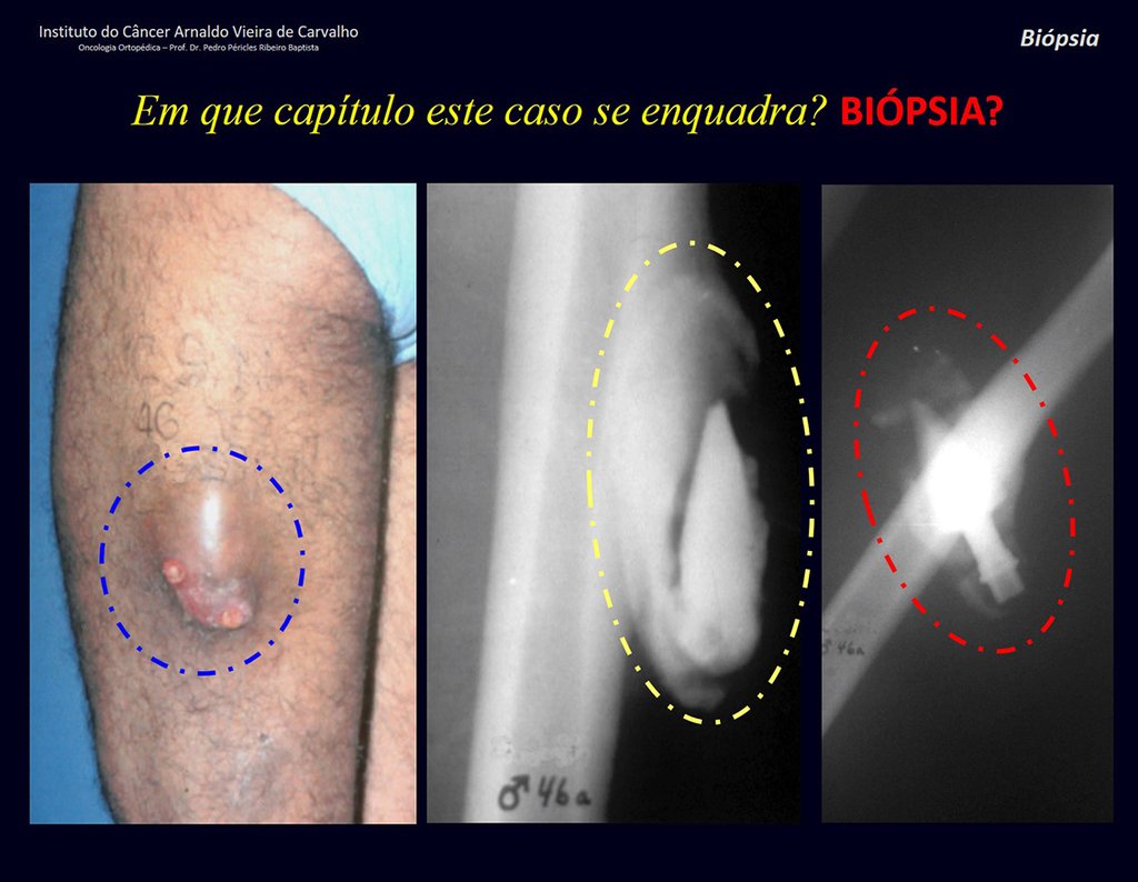 Figura 6: Lesão na coxa assinalada em azul, reação periosteal ao redor de corpo estranho, destacada em amarelo, ponta de lança de portão, circundada em vermelho.