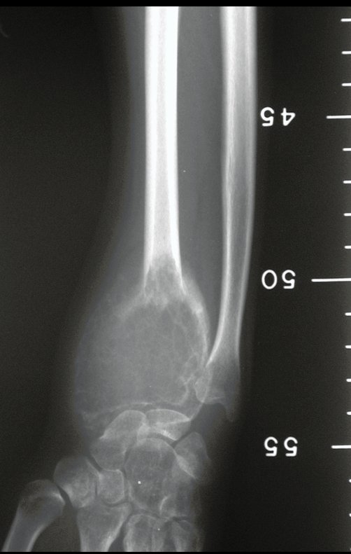 Figura 14: Radiografia com régua, planejamento da ressecção.