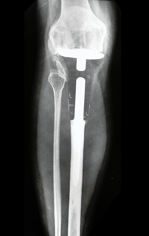 Figura 166: Radiografia, frente, em 18/08/2015. Pós-operatório de dez anos.