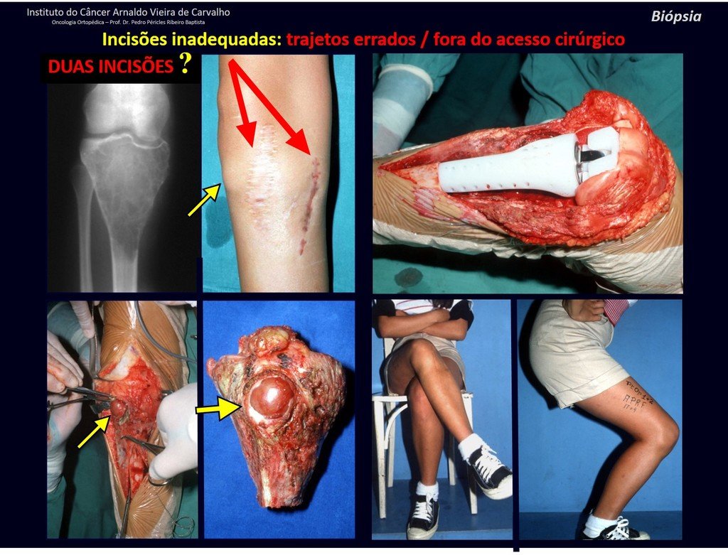 Figura 80: Duas incisões !!! Distantes e com nódulo subcutâneo de implantação de tumor de células gigantes !!!