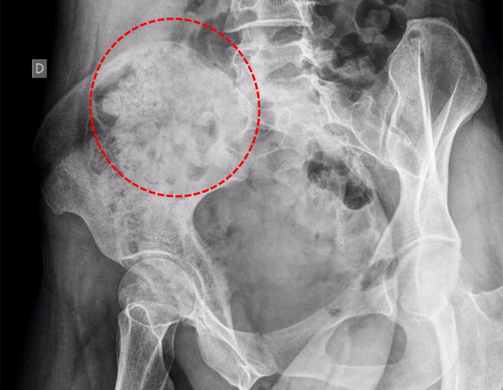 Figura 88: Radiografia de bacia em alar com áreas de rarefação e outras de condensação (focos de calcificação?).