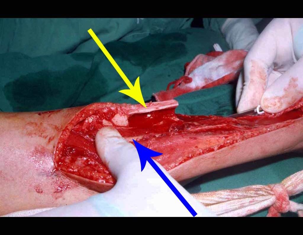 Figura 15: Canaleta aberta lateralmente na tíbia (seta amarela) para permitir o encavilhamento proximal da fíbula (seta azul), sem lesar a artéria nutrícia, mantendo os 2/3 distais da fíbula como um autotransplante vascularizado.