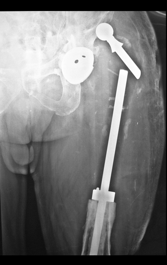 Figura 68: Radiografia do quadril luxado, em julho de 2014, após três meses da revisão.