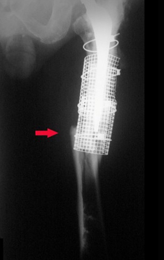 Figura 5: Fratura do fêmur no final da haste femoral curta, em setembro de 2008, apenas quatro meses após a segunda cirurgia, do lado esquerdo.