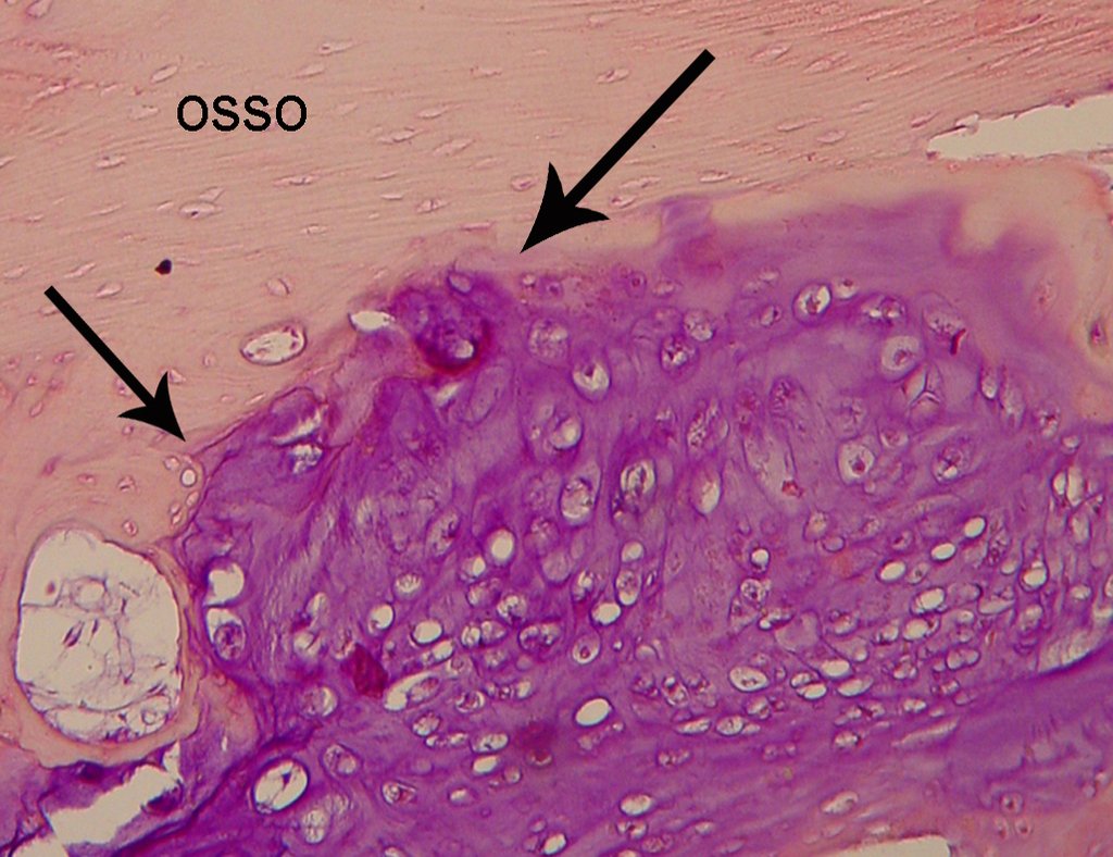 Figura 11: Lâmina de condrossarcoma grau I. Tecido cartilaginoso, com vacúolos contendo mais de um núcleo. Imagem de erosão do tecido ósseo pelo avanço do tumor