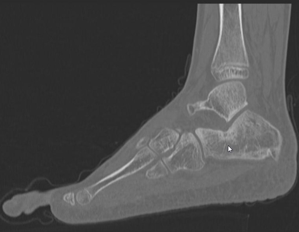 Figura 15: TC de perfil, evidenciando a lesão no calcâneo esquerdo.