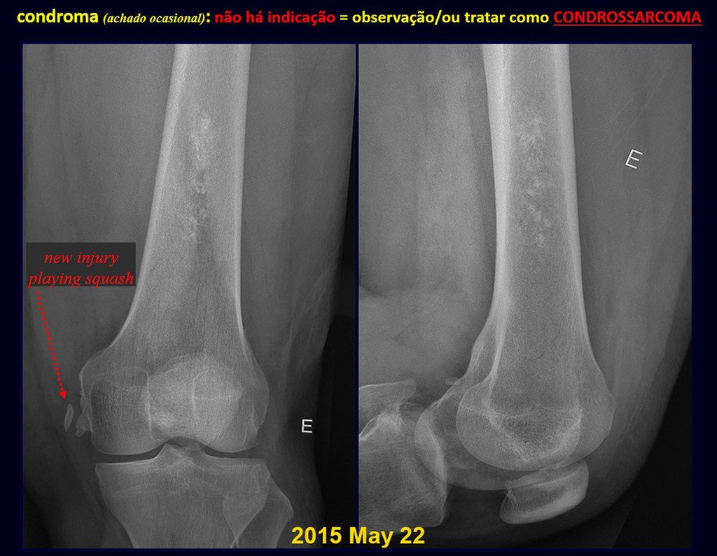 Figura 41: Radiografia de controle após doze anos, queixa de dor recente no joelho. Calcificação na interlinha medial, paciente joga Squash! A dor não tem nada a ver com a lesão em acompanhamento, que continua inalterada.