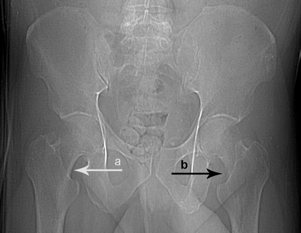 Figura 10: Radiografia da bacia frente, em 20/02/2015, mostrando lesão lítica no colo femoral medial esquerdo, seta b, compare o colo femoral normal do lado direito, seta a.