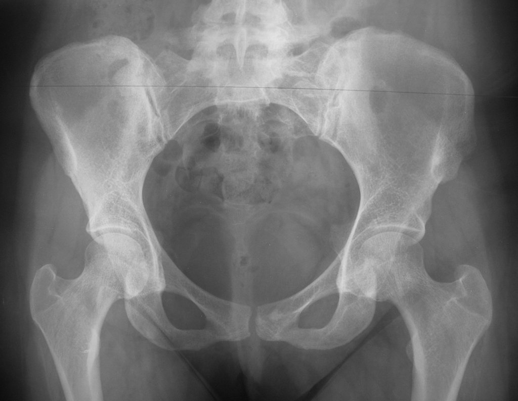 Figura 31: Radiografia da bacia, frente, local da retirada de enxerto da crista ilíaca esquerda, após 22 anos.