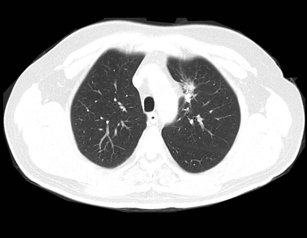 Figura 60: Tomografia de tórax com a cicatriz da lesão pulmonar.