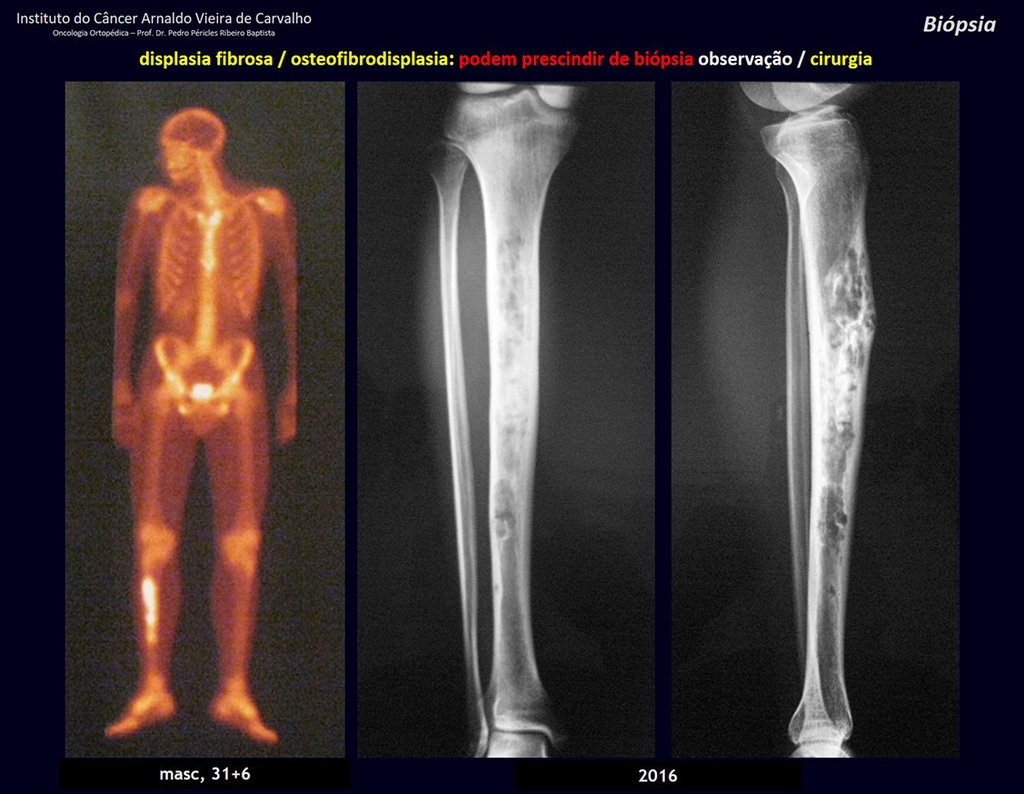 Figura 69: Cintilografia e radiografias de 2016, após vinte e cinco anos de observação, sem biópsia. Paciente adulto, tíbia alinhada.