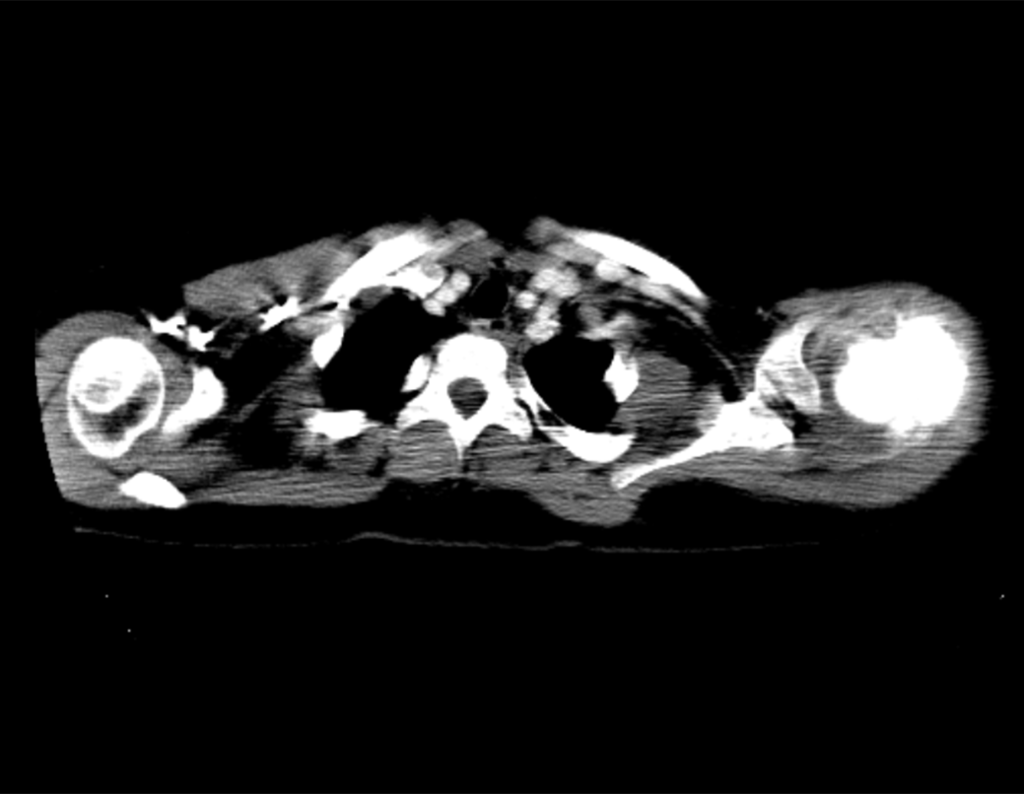 Figura 8: Tomografia pós quimioterapia com lesão no úmero esquerdo, obliterando o canal medular e com reação periosteal espicular.