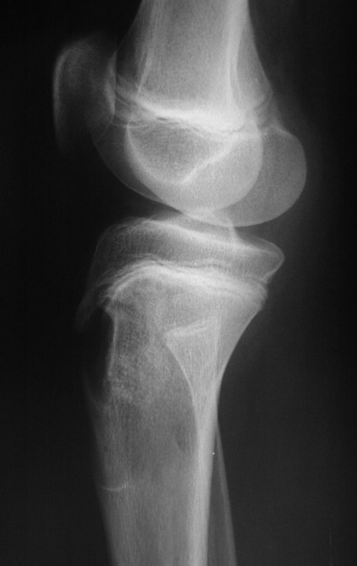 Figura 18: Radiografia pré-operatória, perfil, de outubro de 1999, pós quimioterapia, com boa resposta ao tratamento neoadjuvante.