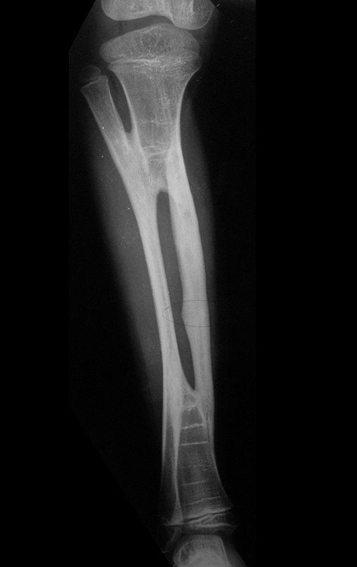 Figura 128: Radiografia em 20/04/2013, após dois anos e dois meses da cirurgia e onze meses após a fratura de stress do osso de banco. Observe que a cicatriz do calo encontra-se mais distal, devido ao crescimento da tíbia.