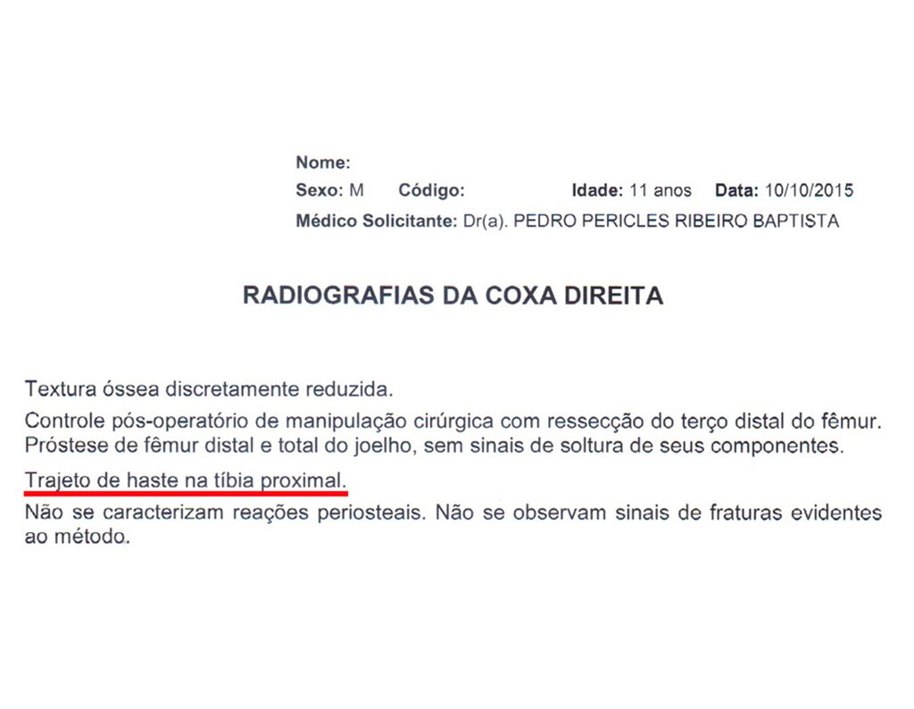 Figura 159: Laudo da radiografia de 10/10/2015, referindo trajeto de haste na tíbia proximal.