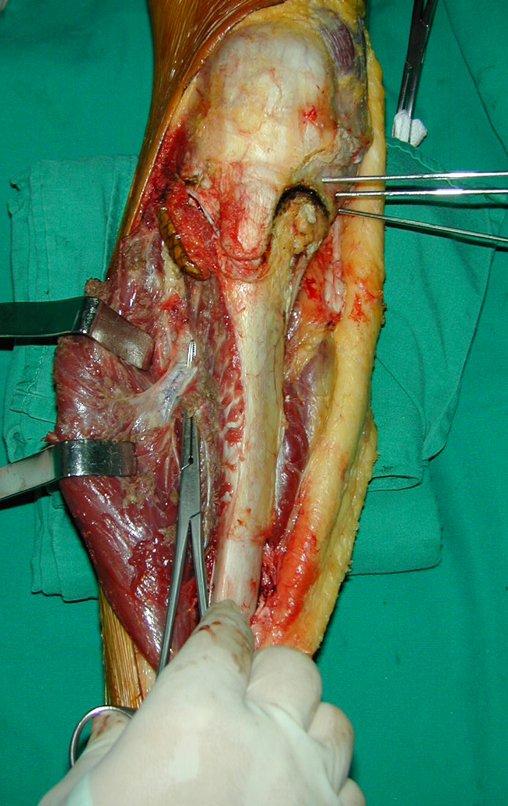 Figura 32: Dissecção do músculo tibial anterior, deixando algumas fibras musculares, o perimísio e o periósteo como margem lateral.