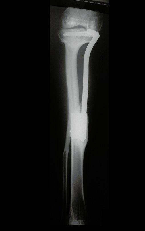 Figura 147: Radiografia de 13/12/2005, após seis anos e dois meses, com boa hipertrofia da fíbula e bom alinhamento do membro operado.