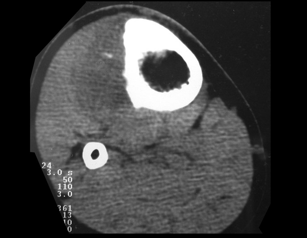 Figura 7: Tomografia de 29/04/1999, corte mais inferior do 1/3 proximal da tíbia, com lesão extracortical na região ântero-lateral, densidade para osso.