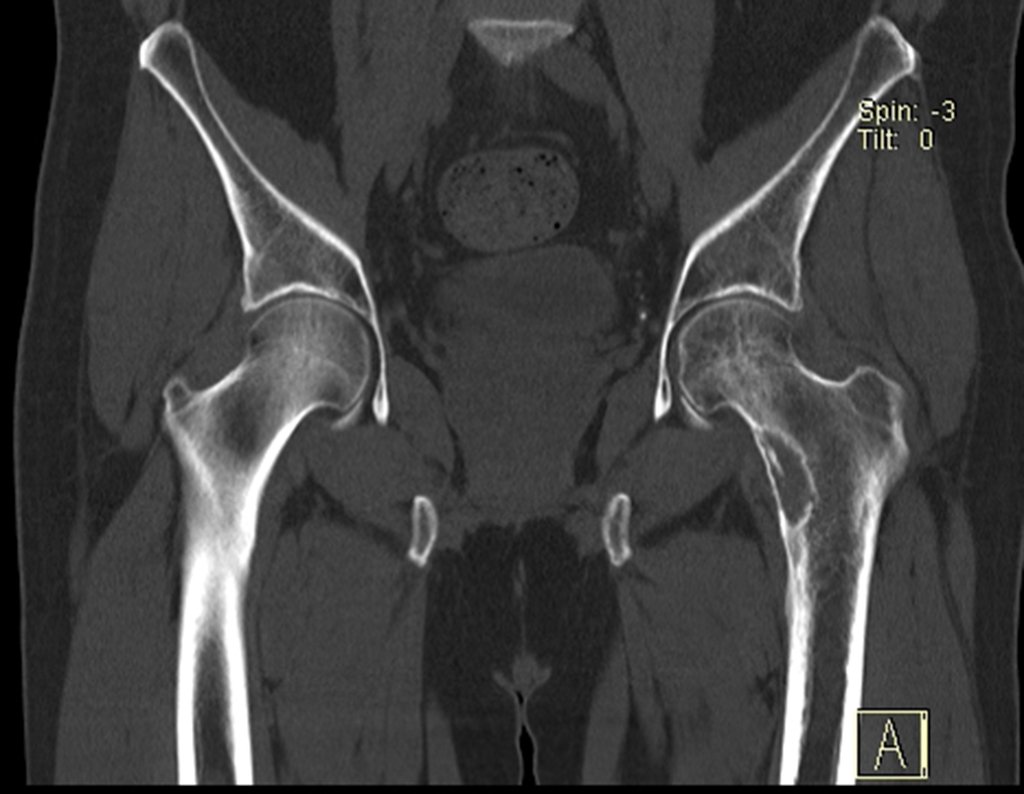 Figura 67: Tomografia coronal com lesão no colo esquerdo e rarefação em todo o 1/3 proximal, comparativamente com o lado direito.