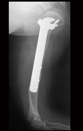 Figura 30: Radiografia de controle, perfil, após 22 anos.