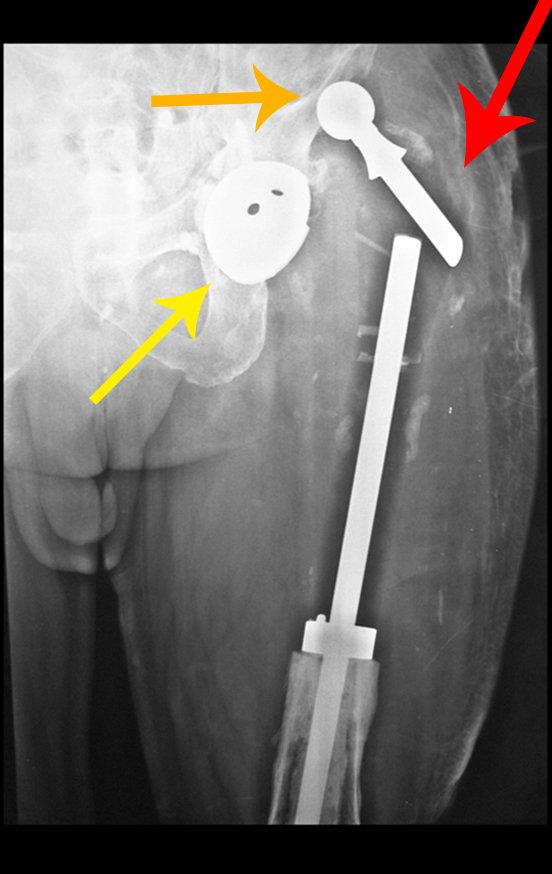 Figura 69: Prótese luxada: falta de troca do acetábulo, seta amarela; cabeça femoral pequena, seta laranja e insuficiência do médio glúteo, seta vermelha.