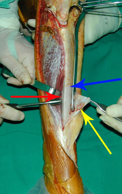 Figura 30: Após a marcação do trajeto dos parafusos da epífise tibial com fios de Kirschner, procede-se à dissecção distalmente, deixando o periósteo da tíbia como margem medial - seta azul, o perimísio do musculo tibial anterior como margem lateral - seta vermelha e rebate-se o periósteo abaixo do nível da osteotomia - seta amarela, preservando-o.