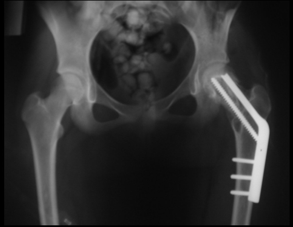 Figura 82: Radiografia do pós-operatório imediato, frente.