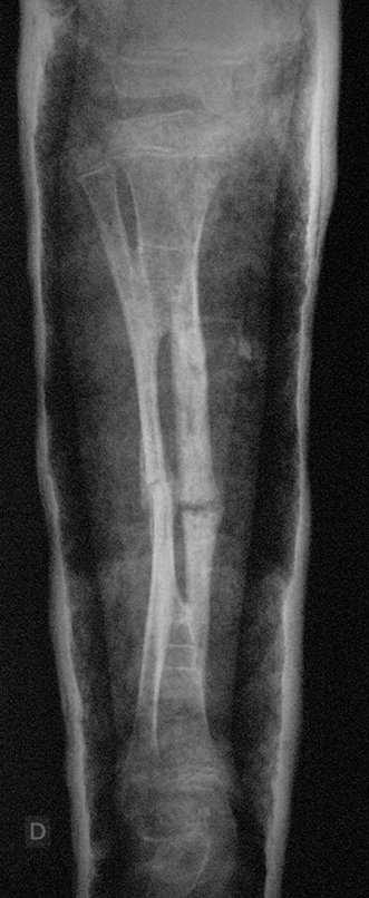 Figura 144: Radiografia de controle após oito semanas, frente, em 06/12/2013.