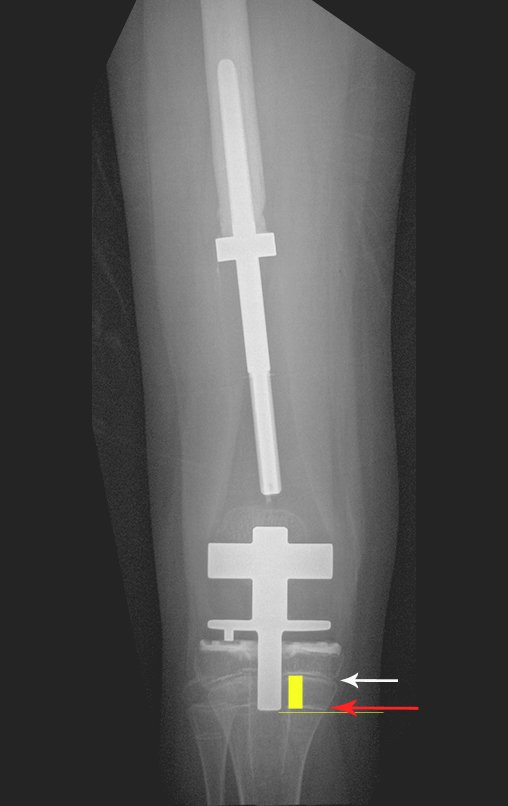 Figura 155: Radiografia frente em 10/10/2015, após dezessete meses de operado. Seta branca aponta a fise de crescimento, seta vermelha a linha da cicatriz da antiga posição da fise de crescimento. Barra em amarelo assinala o quanto cresceu esta parte da tíbia.