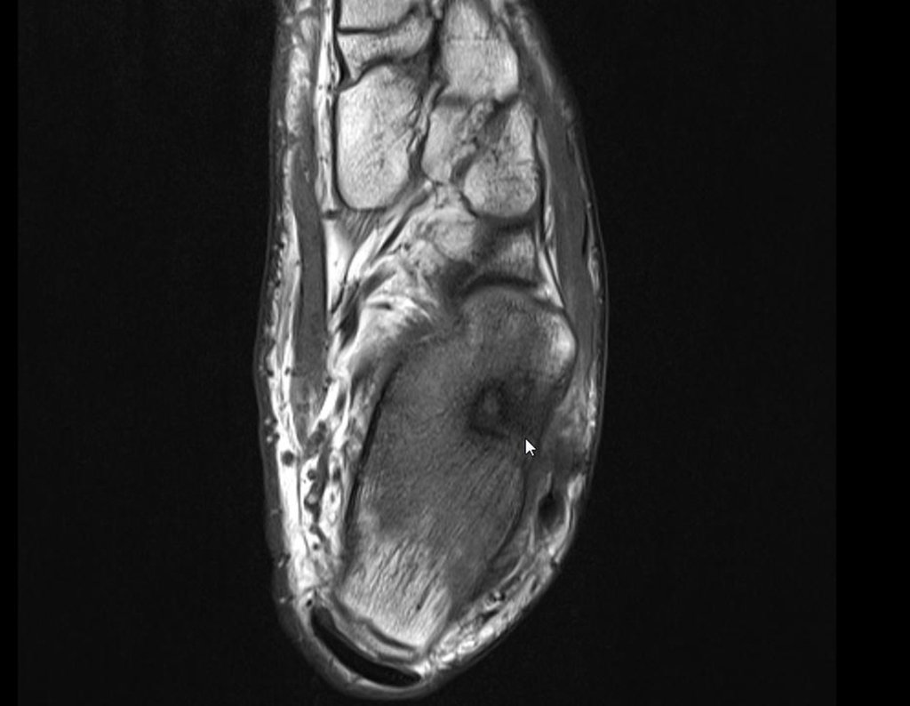 Figura 24: RM axial T1, detalhe do halo de esclerose ao redor da lesão.