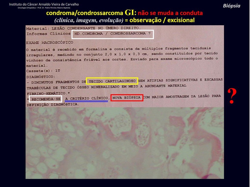 Figura 48: Laudo de biópsia realizada, revela tratar-se de lesão cartilaginosa sem atipias, nesta amostra recomendando nova biópsia? Precisa? Que conduta o médico tomaria se em uma eventual nova biópsia, a qual continuaria sendo uma amostra, continuasse a impressão de condroma? Deve-se considerar o comportamento evolutivo da lesão e tratar como condrossarcoma.