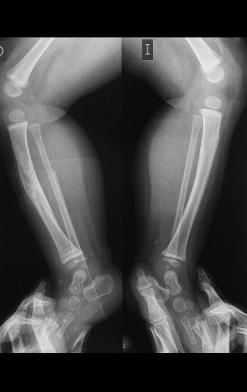 Figura 17: Em maior detalhe o comprometimento da tíbia direita, na radiografia em perfil.