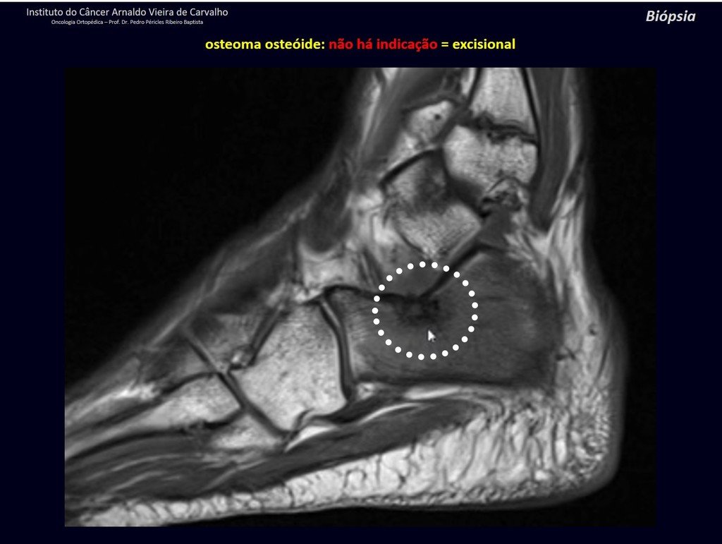 Figura 26: Osteoma osteóide sub talar do calcâneo. Não há indicação de biópsia.