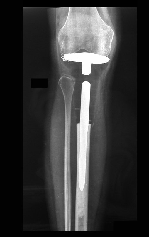 Figura 101: Prótese parcial de tíbia, com preservação dos meniscos e ligamentoplastia, estável e bem alinhada.